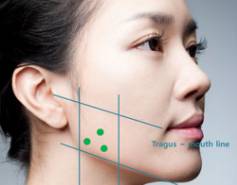 肉毒桿菌毒素改善咀嚼肌肥大