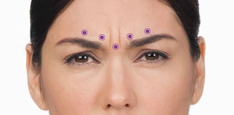 楊浩康(Yeung Ho Hong)醫生講解肉毒桿菌毒素-改善皺眉紋-眉間皺紋