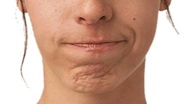 肉毒桿菌毒素改善酒窩下巴 (Cobblestone Chin) - 楊浩康醫生