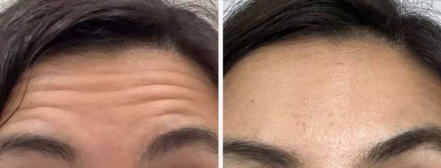 楊浩康(Yeung Ho Hong)醫生講解肉毒桿菌毒素改善抬頭紋