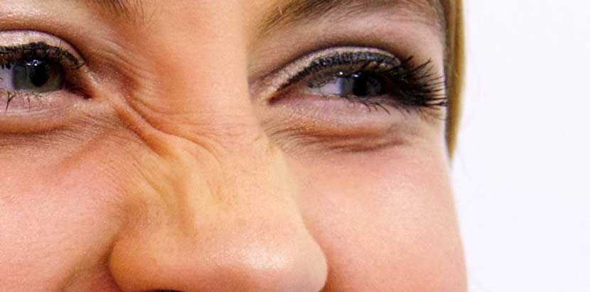 楊浩康(Yeung Ho Hong)醫生講解改善鼻樑上的皺紋? - 肉毒桿菌毒素注射